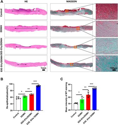 Aerobic exercise-induced circulating extracellular vesicle combined decellularized dermal matrix hydrogel facilitates diabetic wound healing by promoting angiogenesis